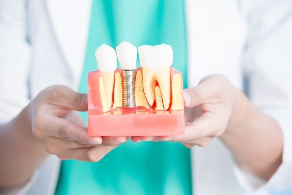 Dental Implants In New Westminster